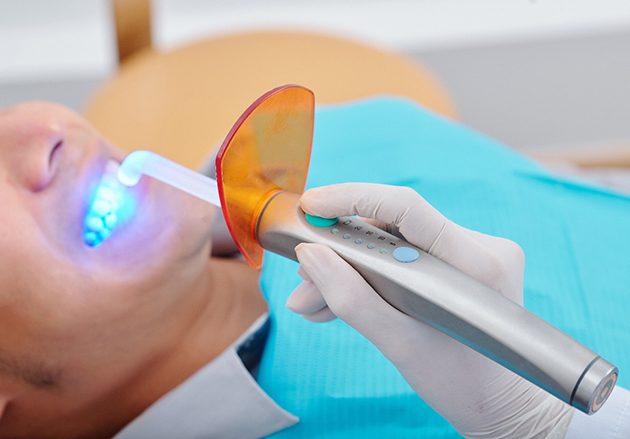 A dentist using a curing light to harden the composite resin into place