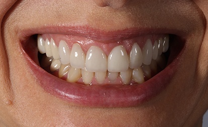 Close up of flawless smile after dental veneers