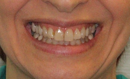 Close up of imperfect smile before dental veneers
