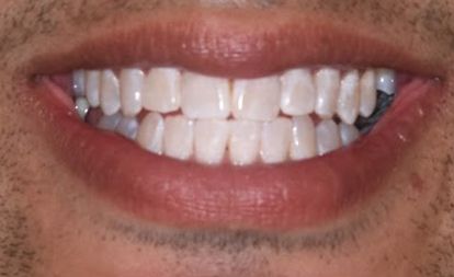 Close up of flawless smile after teeth whitening