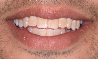 Close up of imperfect smile before teeth whitening