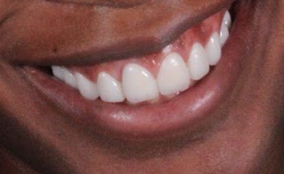 Close up of flawless teeth after dental veneers