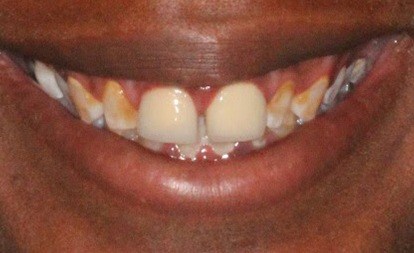 Close up of imperfect teeth before dental veneers