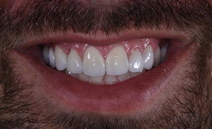 Close up of flawless teeth after gum surgery and veneers