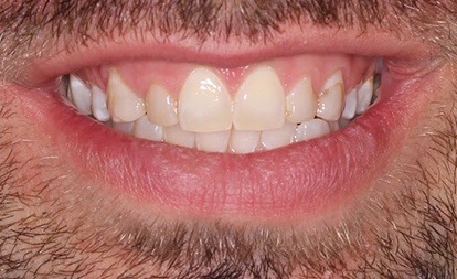 Close up of imperfect teeth before gum surgery and veneers