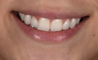 Close up of flawless teeth after Invisalign and veneers