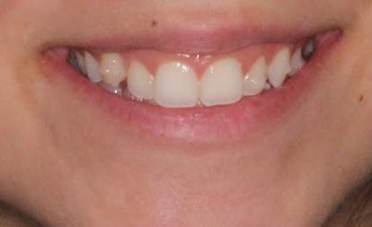 Close up of imperfect teeth before Invisalign and veneers