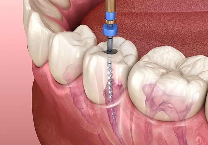 illustration of root canal therapy