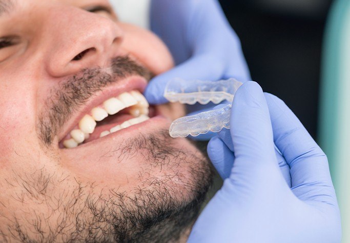 putting invisalign on man with beard