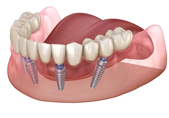 Diagram of All-On-4 dental implants in Plainview 