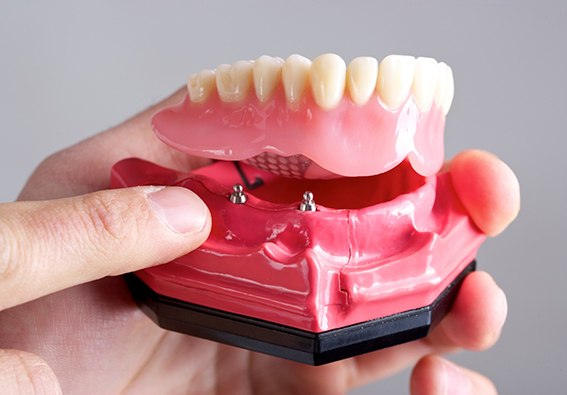 Plainview implant dentist holding model of All On 4 dental implants