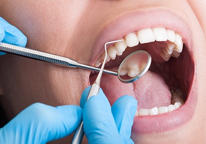 dentist looking in patients mouth