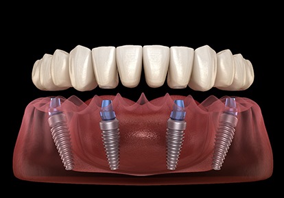 A 3D illustration of All-on-4 dentures
