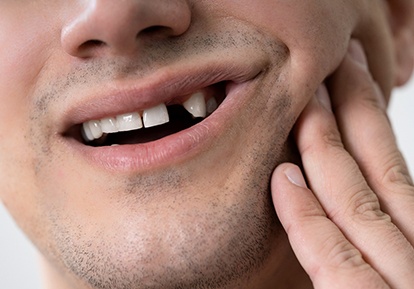 man smiling with missing tooth 