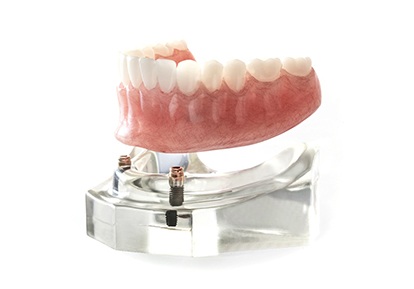 Implant dentures in Plainview on white background