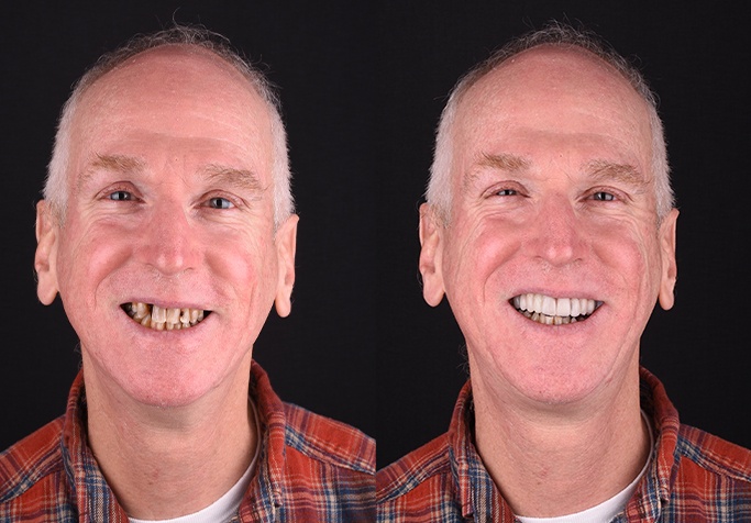 before and after smile design