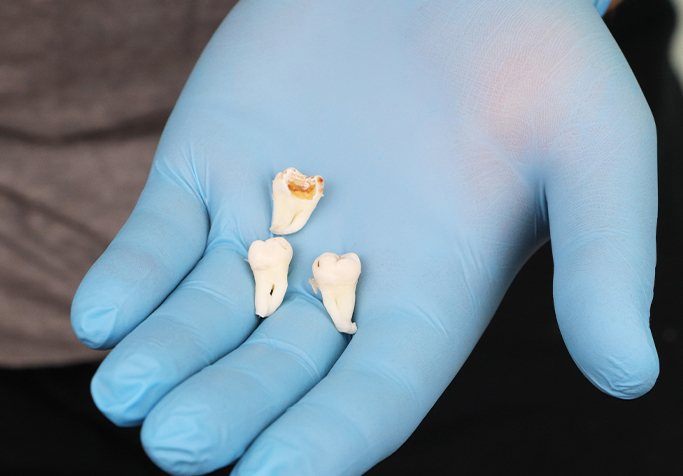 hand holding three extracted teeth
