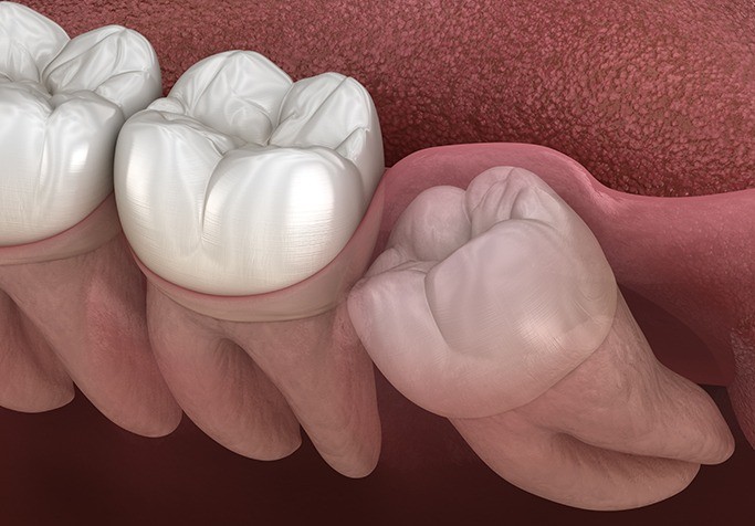 impacted tooth