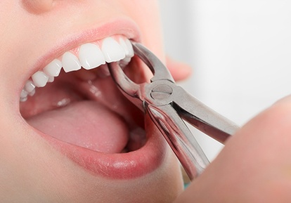 A dentist performing a tooth extraction