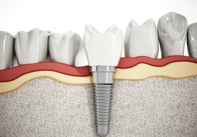 3D image of a dental implant