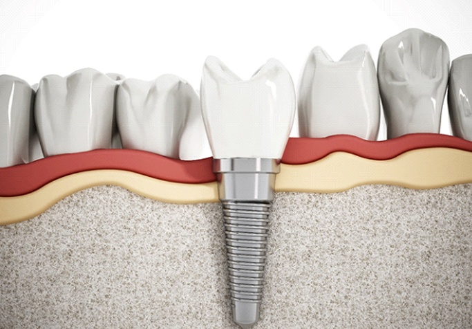 3 D image of a dental implant