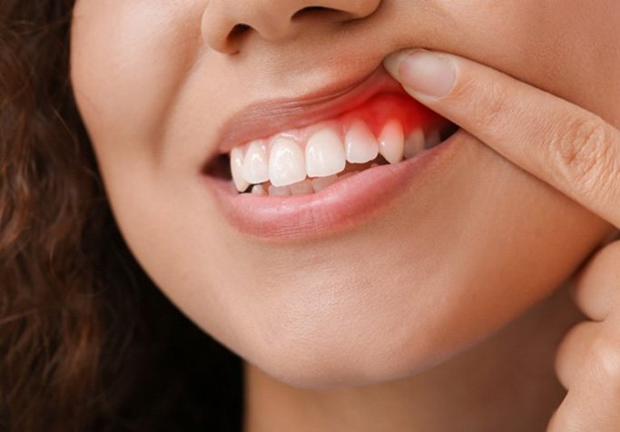 a patient with swollen gums