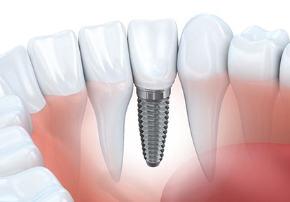 An older woman pleased with her new dental implants in Plainview