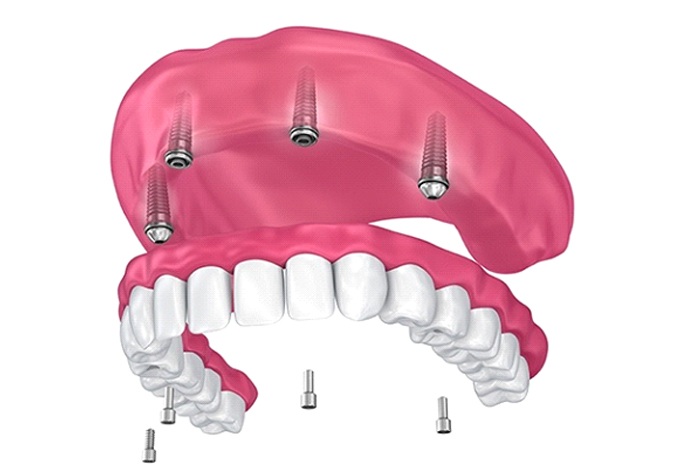 implant denture on the upper arch