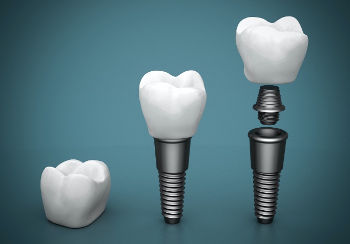 dental implant crown, abutment, and post 
