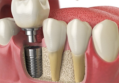 dental implant being placed in the lower jaw