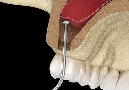 model of a sinus lift