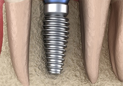 dental implant post in the jawbone