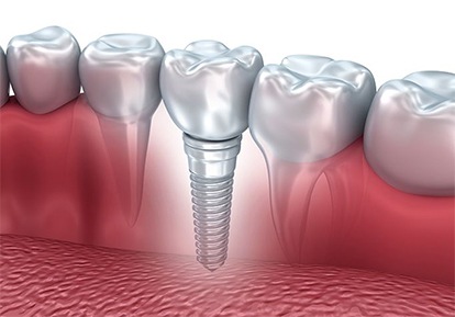 dental implant with crown