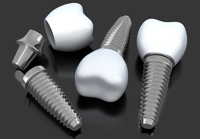 three dental implant posts with abutments and crowns