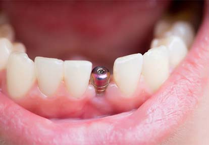 Dental implant in Plainview