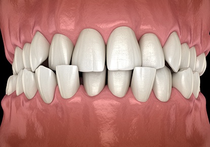 Illustration of crossbite