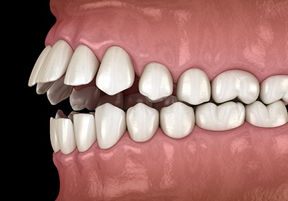 Illustration of openbite