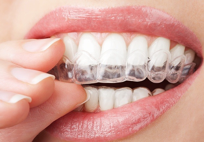 close up of woman putting in invisalign