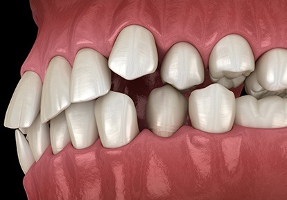 computer illustration of crowded teeth