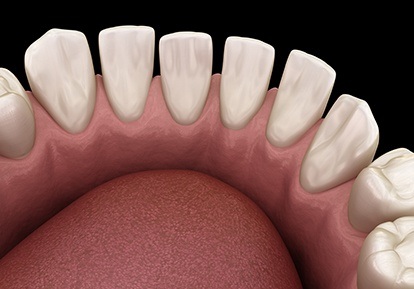 computer illustration of spaced out teeth