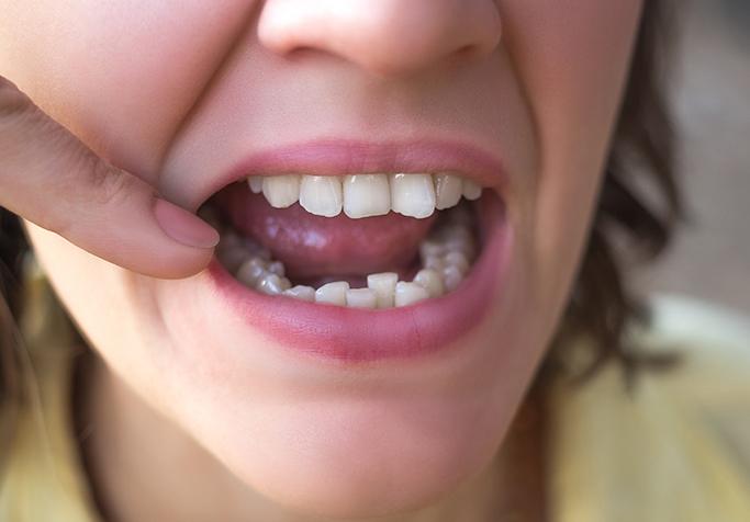 woman pointing to overcrowded teeth