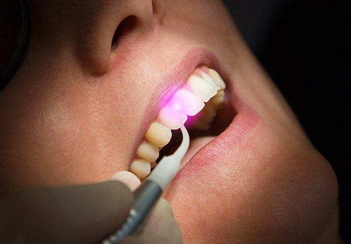 soft tissue laser behind smile