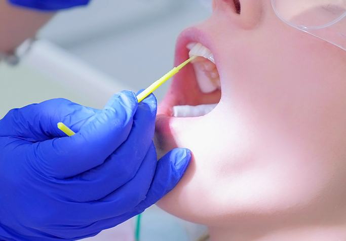 woman having fluoride treatment done