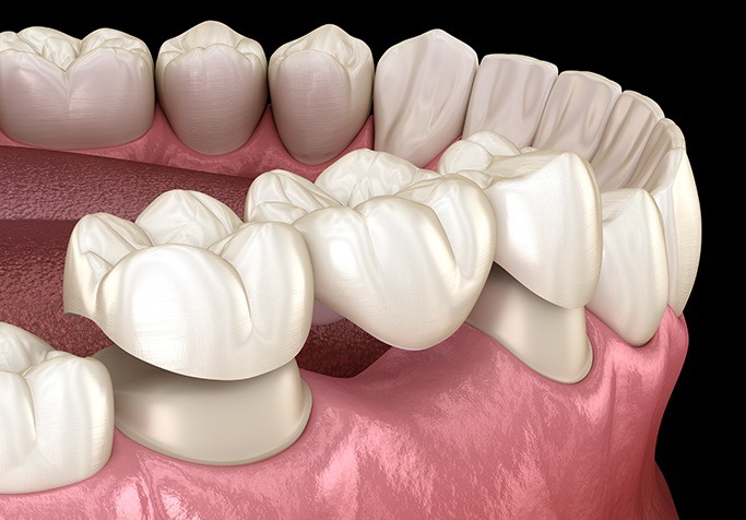 dental bridge