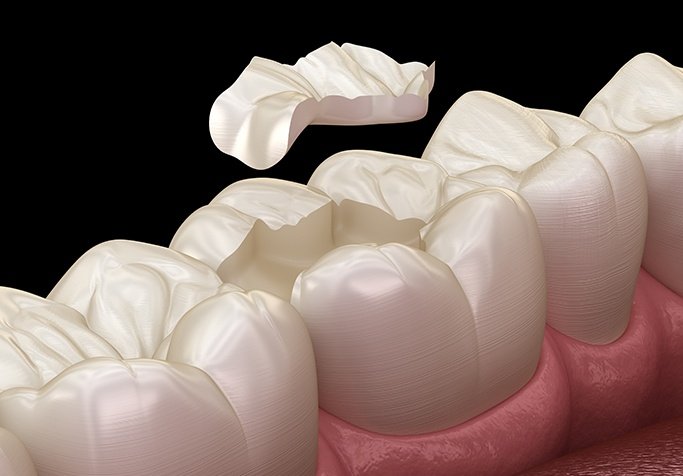 illustration of tooth colored fillings