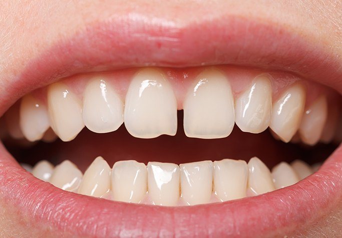 close shot of top teeth gapped