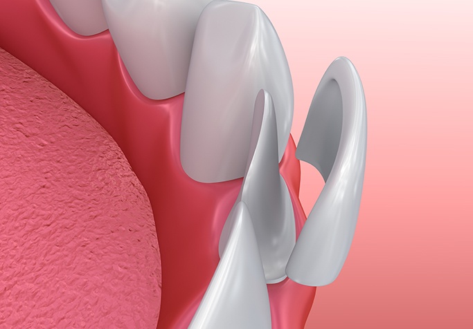 computer illustration of porcelain veneers