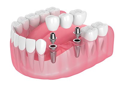 A digital image of an implant bridge replacing three missing teeth along the lower arch