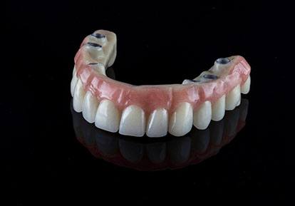 A customized implant denture complete with six areas in which the implants will connect when put into place
