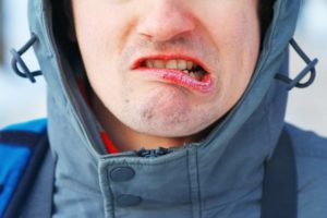 person with dry, cracked lips